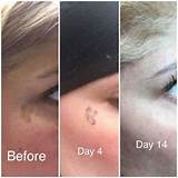 Pictures of Spot Removal Laser Treatment