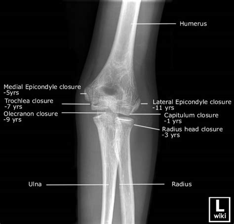 Pediatric Elbow Anatomy Radiologypicscom