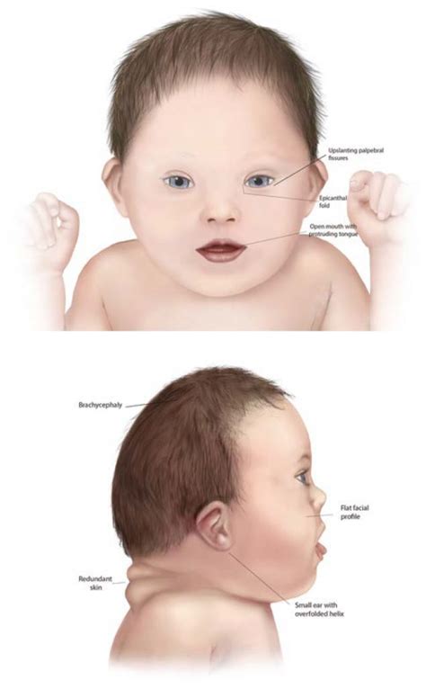 List of 12 disease causes of epicanthal folds in children, patient stories, diagnostic guides. Epicanthal Folds Down Syndrome ~ news word