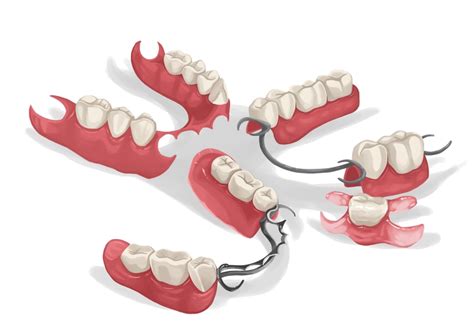 Partial Dentures Types Pros And Cons Authority Dental