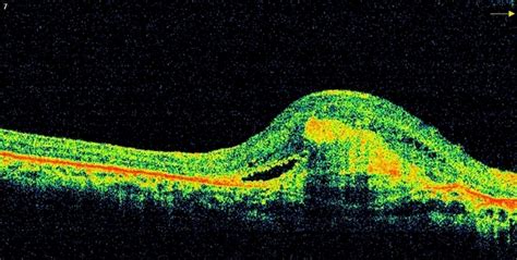Angioid Streaks With Cnvm Oct Re Retina Image Bank