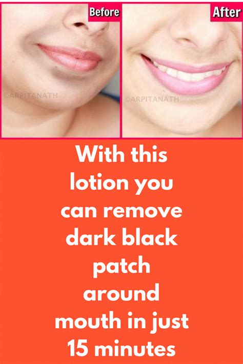 Pin On Skin Whitening Treatment For Dark Skin