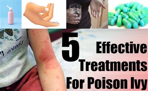 5 Effective Treatments For Poison Ivy Natural Home Remedies And Supplements