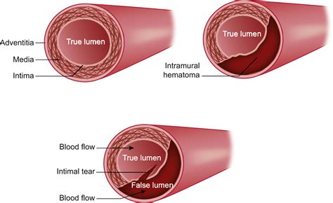 Spontaneous Coronary Artery Dissection A Comprehensive Overview