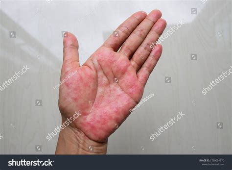 Atopic Dermatitis Ad Known Atopic Eczema Stock Photo 1790054570