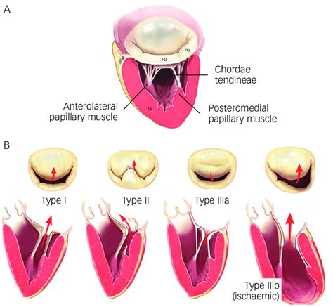 Carpentier´s Classification Of Mitral Regurgitation Download