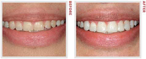The Differences Between Veneers And Bonding You Probably Didnt Know