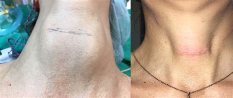 Post Operative Incisions Scars Gallery Austin Thyroid Surgeons