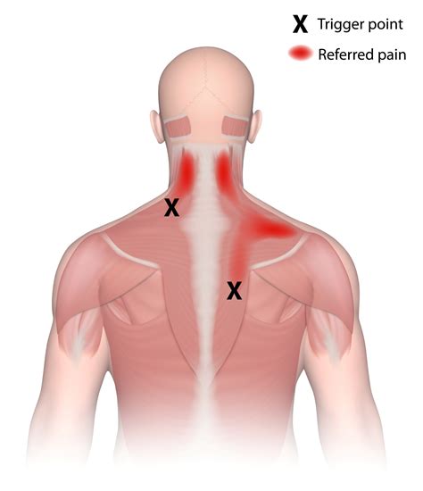 Types Of Massage Trigger Point And Myofascial Release