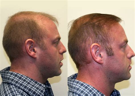 Great Hair Transplants Patient Jesse Page Dr Brett Bolton