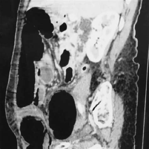 Per Operative View Of The Non Reducible Spigelian Hernia With Necrosis