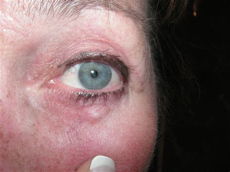 Skin Cancer Skin Cancer Under Eye