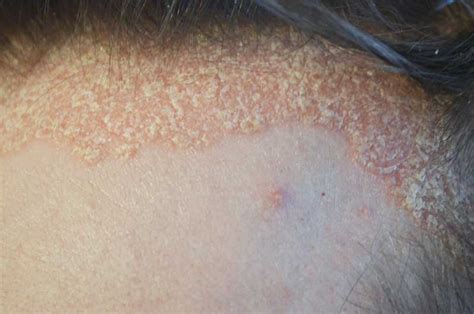 Šta Je Psorijaza Na Koži Glave I Kako Znate Da To Nije Perut Minut
