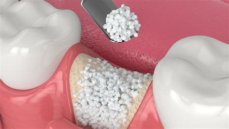 Dental Bone Graft What You Need To Know Body Expert
