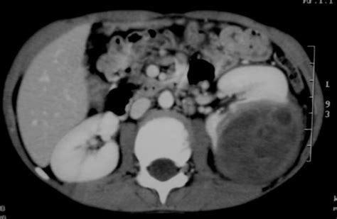Postcontrast Axial Ct Scan Of The Kidneys In A 5 Year Old Male Shows