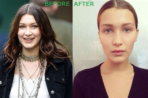 bella hadid plastic surgery before and after 550x364 bella hadid plastic surgery before and
