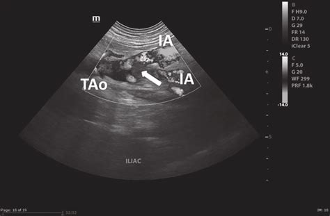 A Sagittal Ultrasonographic View Of The Trifurcation Of The Aorta And