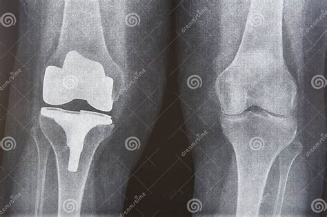 Knee Cap Replacement Xrays Titanium Implant Osteoarthritis Anatomy