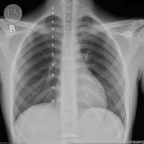 How To Read Chest X Rays International Emergency Medicine Education