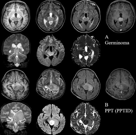 Differentiation Between Germinoma And Other Pineal Region Tumors Using