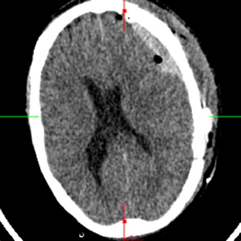 Noncontrast Axial Head Computed Tomography Ct After Decline In