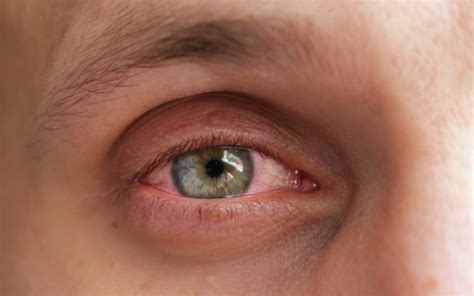 Alergiczne zapalenie spojówek przyczyny objawy i leczenie soczewkidlaciebie pl