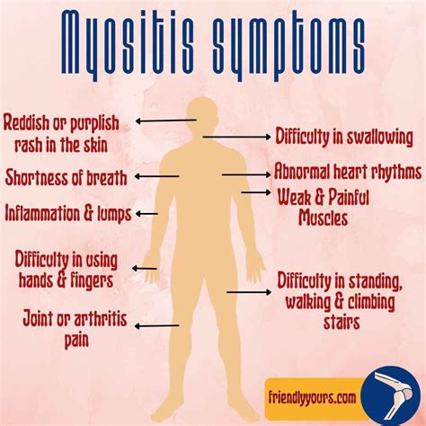 Is There Any Natural Treatment For Myositis Know Its Causes Symptoms Prevention
