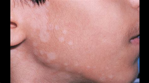 White Spots From Sun Exposure What They Are And How To Treat Them
