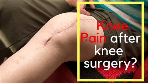 Pain After Knee Replacement Youtube