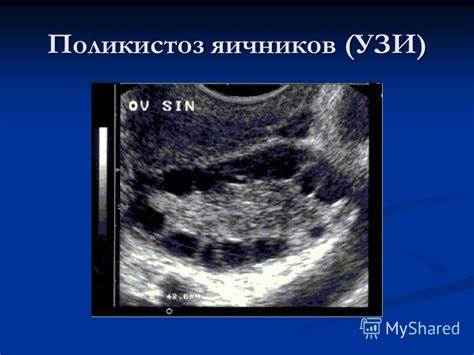 Поликистоз яичник диета Поликистоз яичников фото Поликистоз яичников фото Поликистоз яичник диета