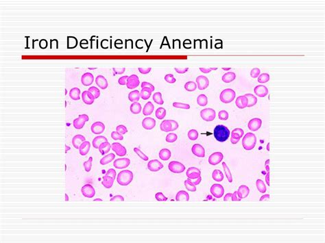 Ppt Anemia Powerpoint Presentation Free Download Id3199320