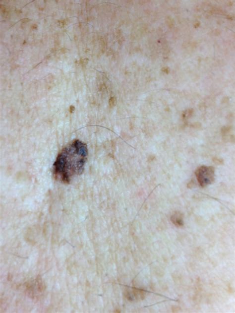 Atypical Moles Diagnosis And Management Aafp