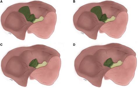 Frontiers State Of The Art In Subtotal Cholecystectomy An Overview