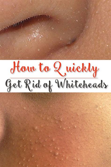 How To Quickly Get Rid Of Whiteheads Your Beauty Architect Beauty