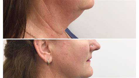 Chin Sculpting Before And After Laser Clinics Australia