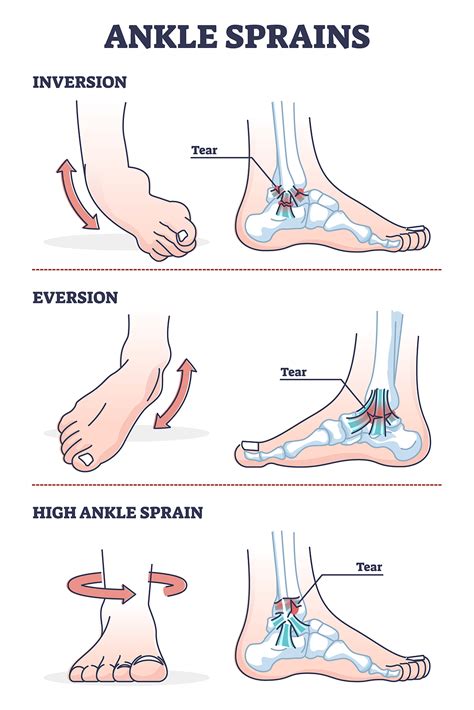Ankle Sprains Situations With Inversion And Eversion Injury Outl Ntfantfa