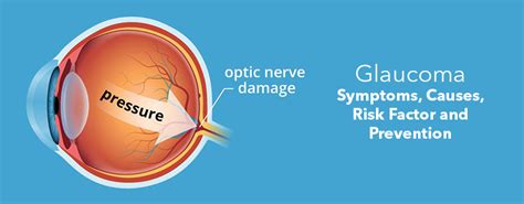 That's why half of people with glaucoma don't. Glaucoma- Symptoms, Causes, Risk Factor and Prevention ...