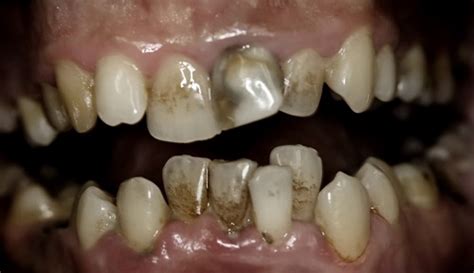 Rotten Teeth Pictures And Treatments New Health Advisor