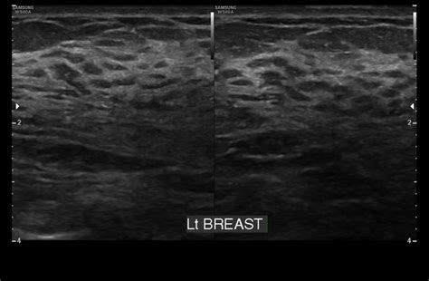 Fibrocystic Disease Of Breast Sono Scan 5d