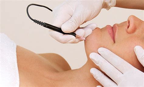 Permanent laser hair removal can be done at any site in the body safely in expert hands without any side effects. Permanent Electrolysis Hair Removal | The Aesthetic Laser ...