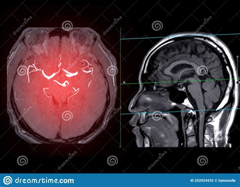 Cta Brain Or Ct Angiography Of The Brain 3d Rendering Image Ap And