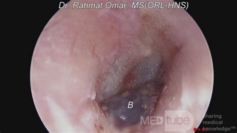 Haemorrhagic Bullous Myringitis Picture