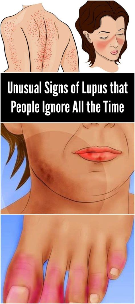 Unusual Signs Of Lupus That People Ignore All The Time Signs Of Lupus