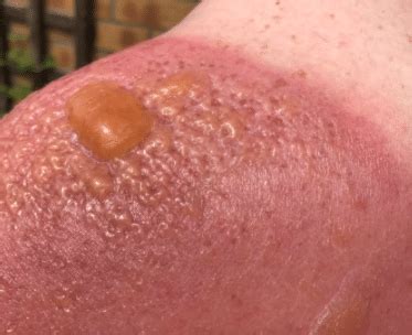 To treat a sunburn, the very best thing you can do is prevent yourself from getting one in the first place. How to Get Rid of Sunburn Overnight, Redness, Pain ...