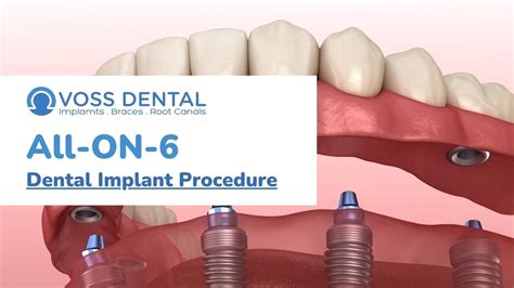 Voss Dental Houston Tx All On 6 Dental Implant Procedure Youtube