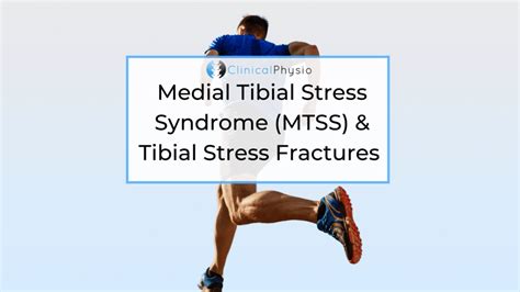 Medial Tibial Stress Syndrome Mtss And Tibial Stress Fractures
