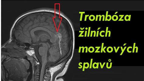 Trombóza Mozkových žilních Splavů Příznaky Projevy Symptomy