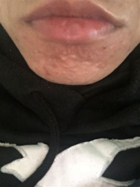 Skin Colored Bumps On Chin Treatment Hypertrophic Raised Scars Forum