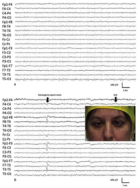 A Interictal Eeg Showing Epileptic Activity Over Left Posterior Leads