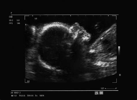 Ultrasound Of A Fetus At 26 Weeks Blogmammait